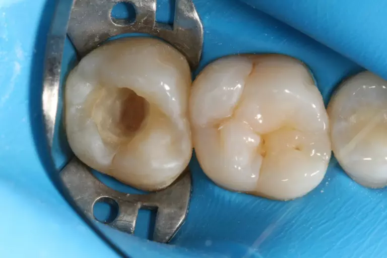 До: Восстановление 17 зуба пломбой с использованием материалов из фотополимеров